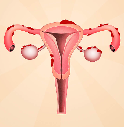 How Endometriosis Can Affect IVF Success