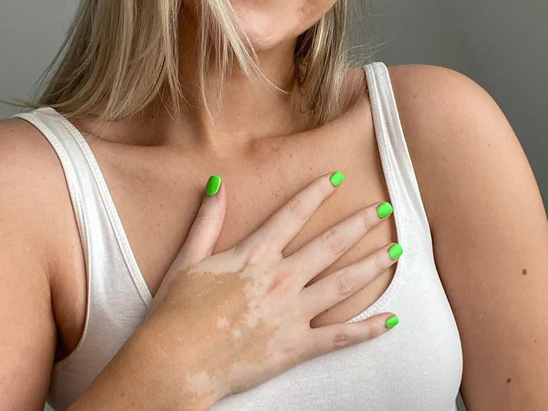 How UVBMEDI products can help you deal with vitiligo