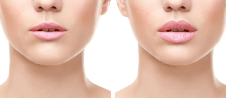 Choosing the Right Type of Lip Filler for You