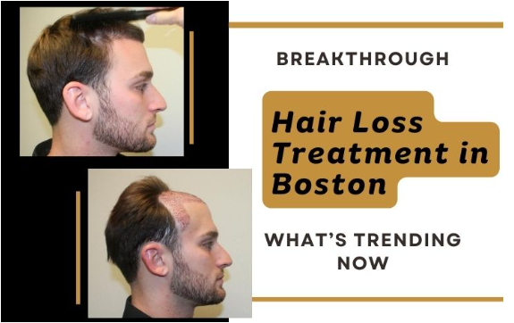 Breakthrough Hair Loss Treatment in Boston: What’s Trending Now